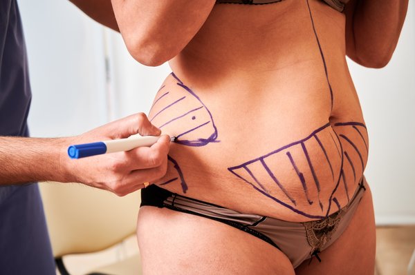 Liposuccion à Bordeaux : transformez votre silhouette en douceur